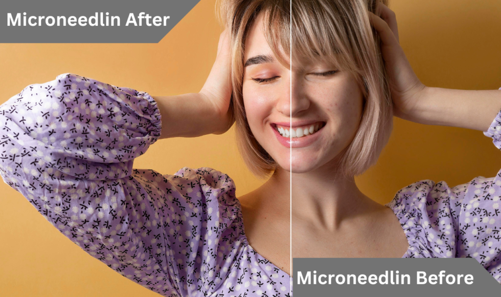 Microneedling before and after