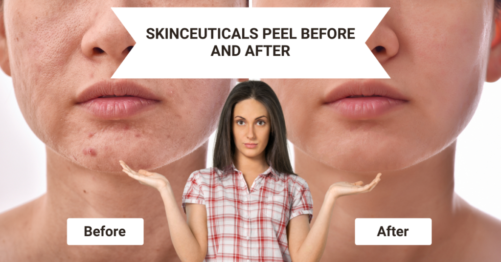 SkinCeuticals Peel Before and After